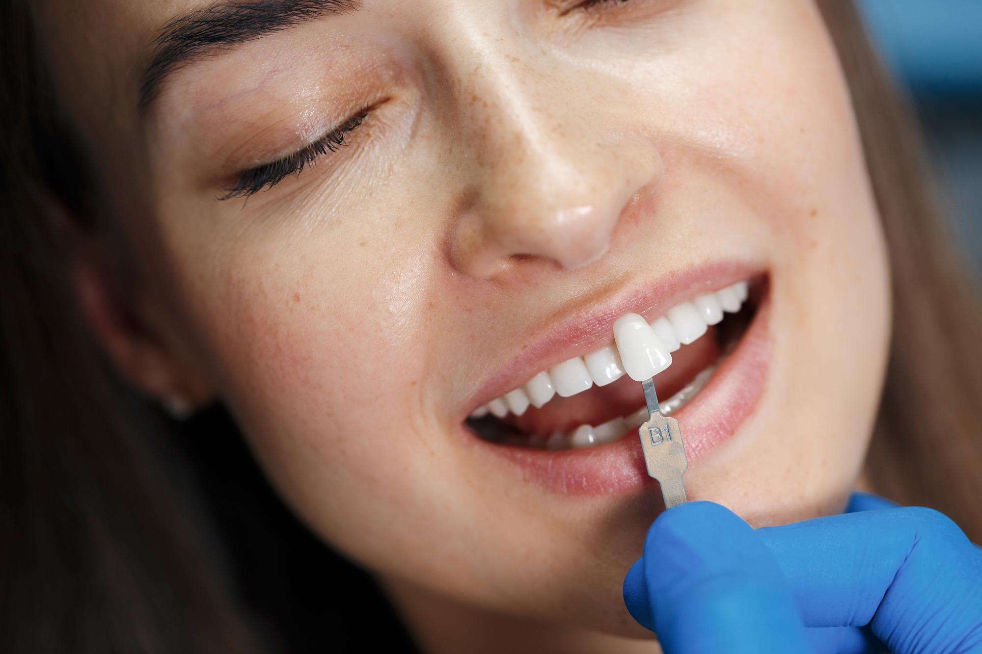 Sorriso perfetto: otturazioni estetiche a Samarate