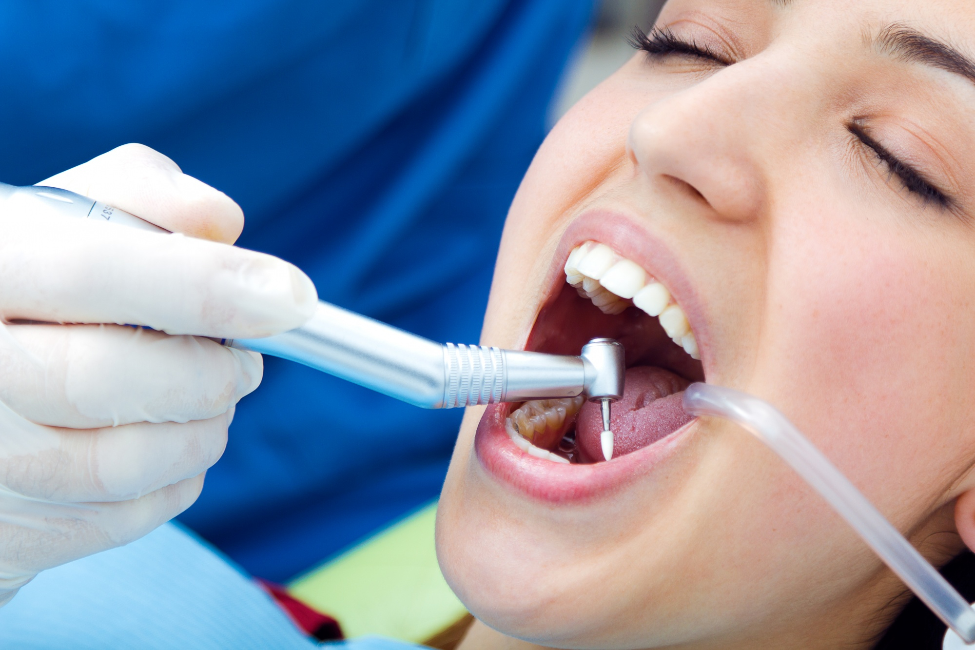 Carie e otturazioni: come prevenire e curare i denti